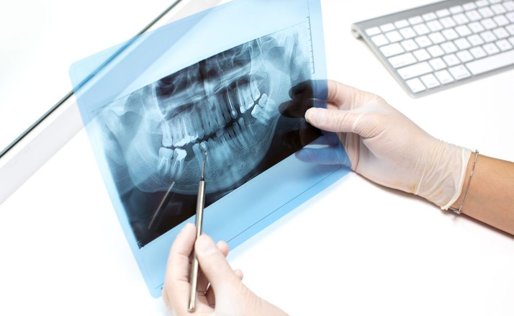 ortopan snimanje zuba