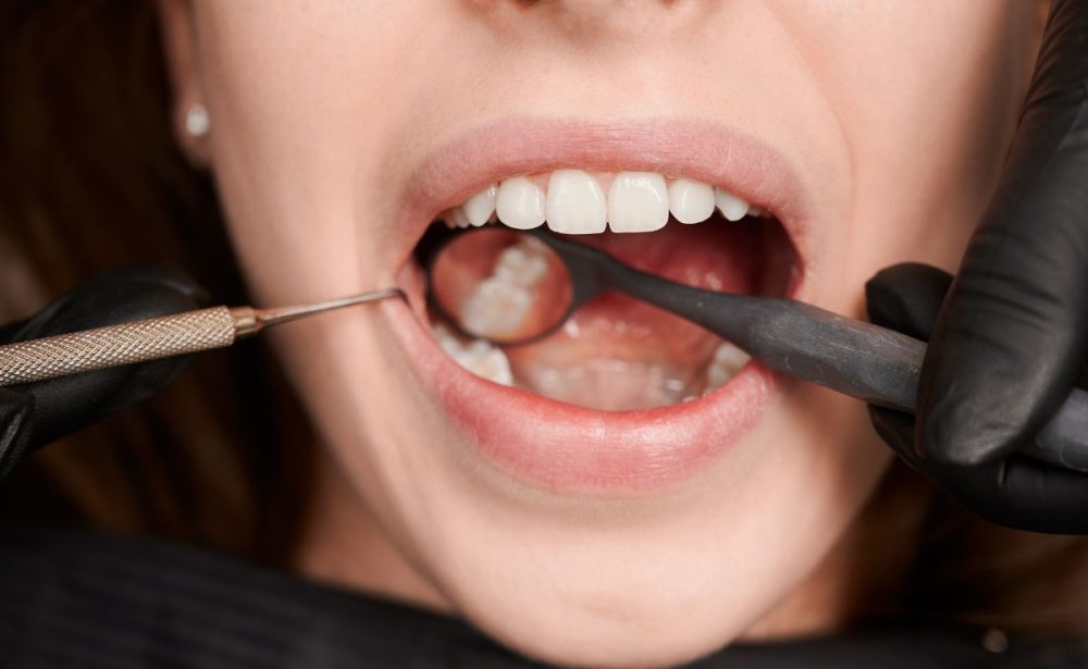 Hirursko vadjenje zuba