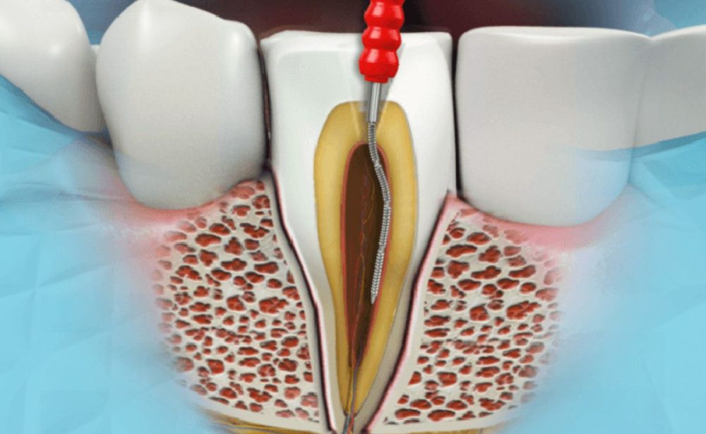lecenje kanala korena endodentska terapija