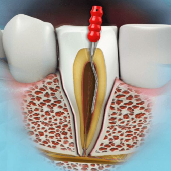 lecenje kanala korena endodentska terapija