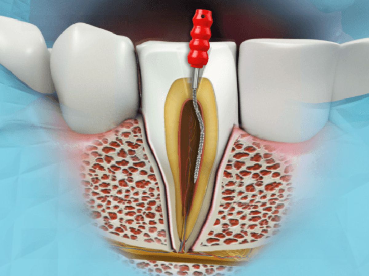 lecenje kanala korena endodentska terapija