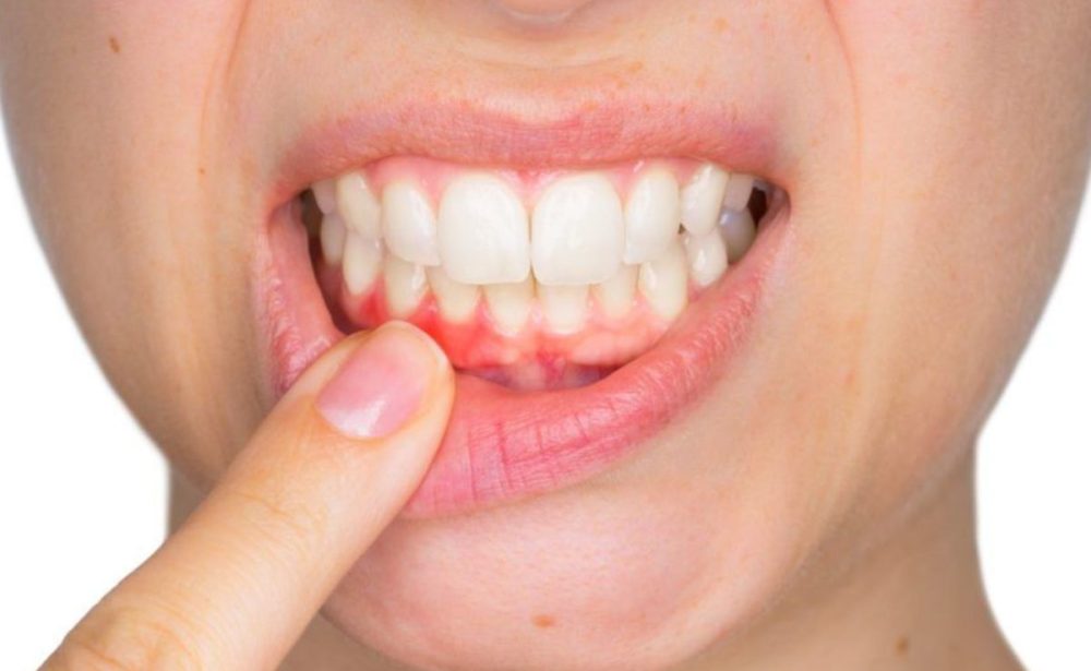 lecenje parodontopatije, parodontoza