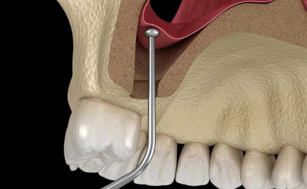 sinus lift