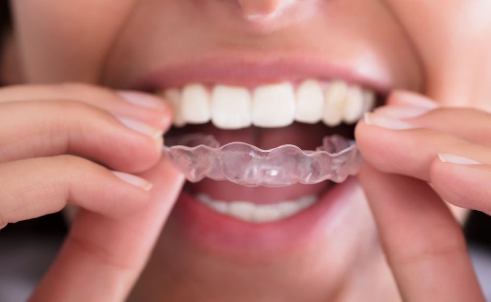 Noćne udlage za zube (bruksizam)